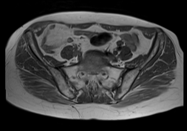 File:Cervical carcinoma (Radiopaedia 88312-104943 Axial T1 6).jpg