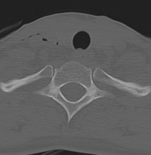 File:Cervical disc replacement (Radiopaedia 37383-39205 Axial bone window 19).png