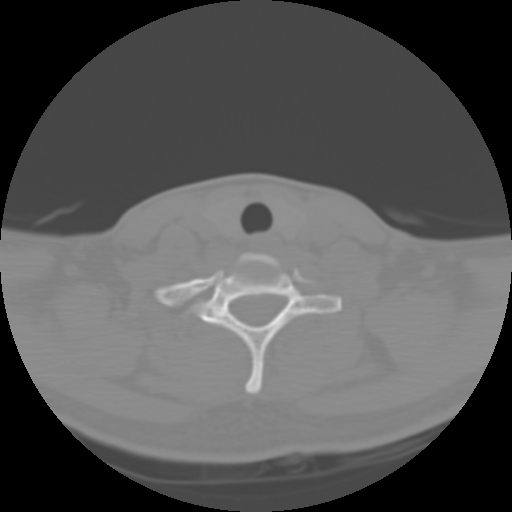 File:Cervical rib (Radiopaedia 71110-81363 Axial non-contrast 43).jpg