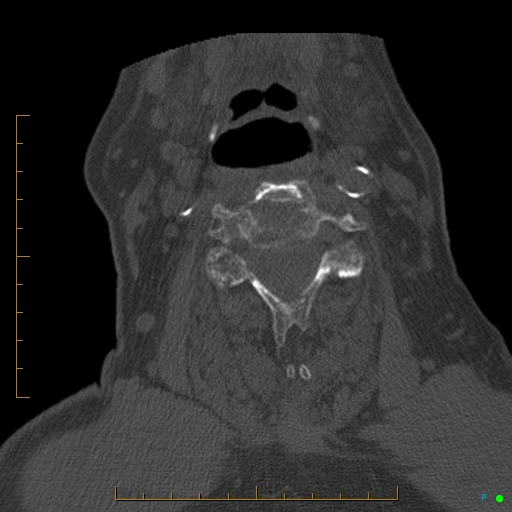 Cervical spine fracture - ankylosing spondylitis (Radiopaedia 76835-88706 Axial bone window 112).jpg