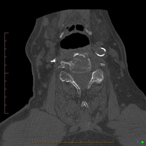 Cervical spine fracture - ankylosing spondylitis (Radiopaedia 76835-88706 Axial bone window 116).jpg