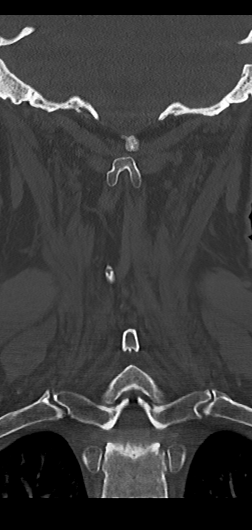 Cervical spine fracture - chalk stick (Radiopaedia 39116-41323 Coronal bone window 38).png