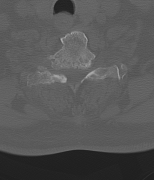 Cervical spine fracture in the setting of ankylosis (Radiopaedia 37038-38715 Axial bone window 48).png