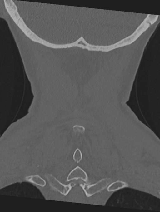 Cervical spondylolysis (Radiopaedia 49616-54811 Coronal bone window 53).png