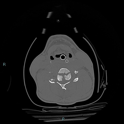 File:Cervical vertebral burst fracture (Radiopaedia 37420-39258 Axial bone window 22).jpg