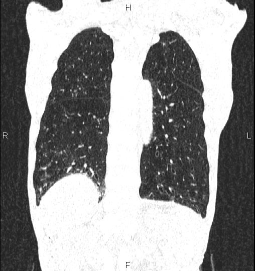 Chilaiditi sign (Radiopaedia 88839-105611 Coronal lung window 50).jpg