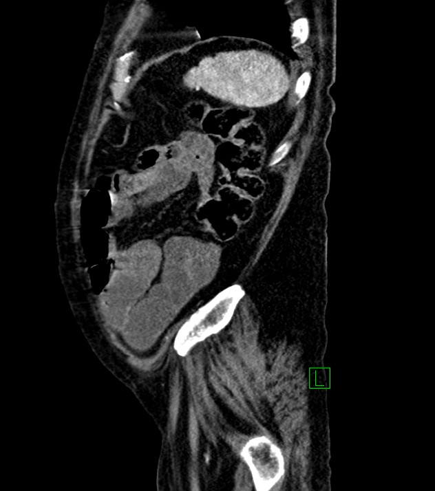 Cholangiocarcinoma with cerebral metastases (Radiopaedia 83519-98629 F 22).jpg