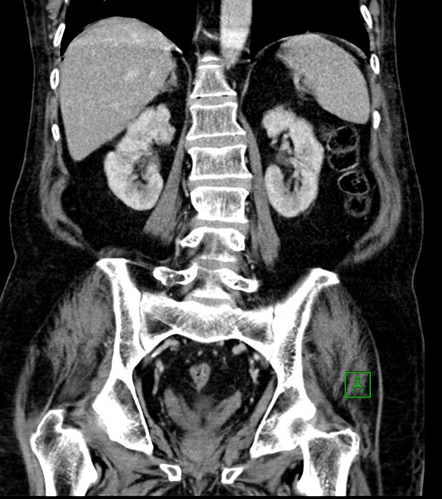 Cholangiocarcinoma with cerebral metastases (Radiopaedia 83519-98629 G 55).jpg