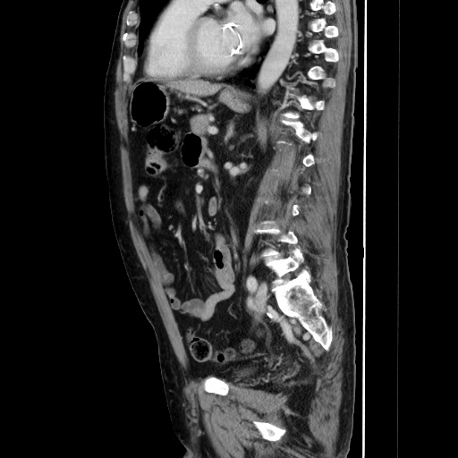 Choledocholiathiasis with normal caliber common bile duct (Radiopaedia 75368-86632 D 98).jpg