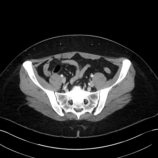 File:Choledocholithiasis after recent cholecystectomy (Radiopaedia 60929-68737 Axial 30).jpg