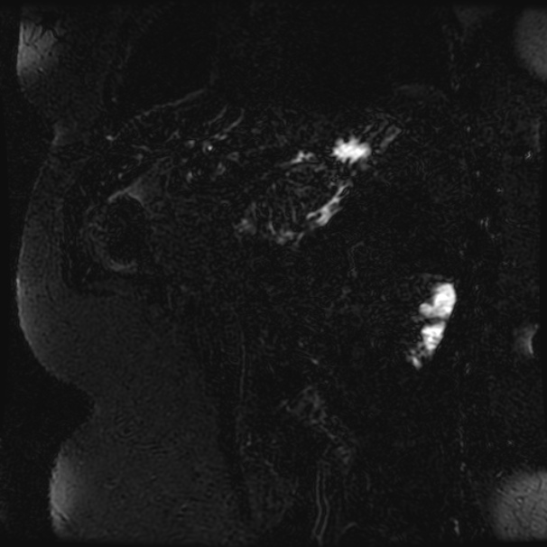 Choledocholithiasis on CT and MRI (Radiopaedia 24825-25088 Coronal T2 90).jpg