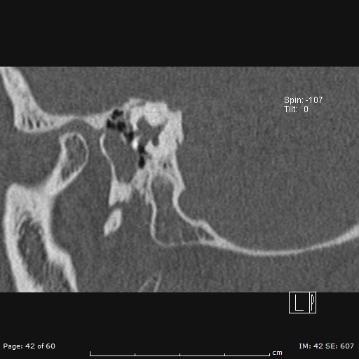 Cholesteatoma - external auditory canal (Radiopaedia 88452-105096 Sagittal bone window 42).jpg