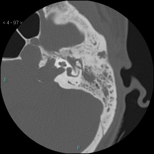 File:Cholesterol granuloma of the petrous apex (Radiopaedia 64358-73141 Axial bone window 47).jpg