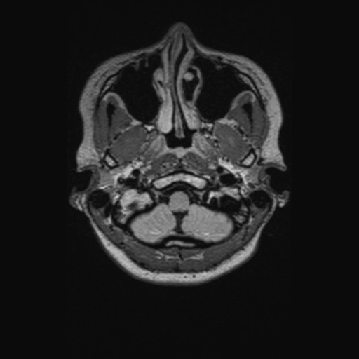 Chondrosarcoma (Radiopaedia 41937-44939 Axial FLAIR 15).png