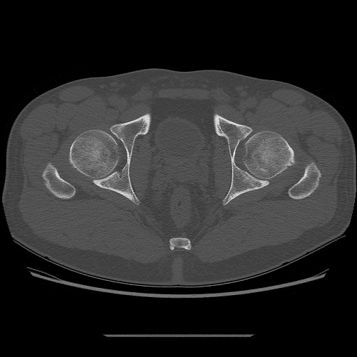 File:Chondrosarcoma of iliac wing (Radiopaedia 63861-72599 Axial bone window 105).jpg