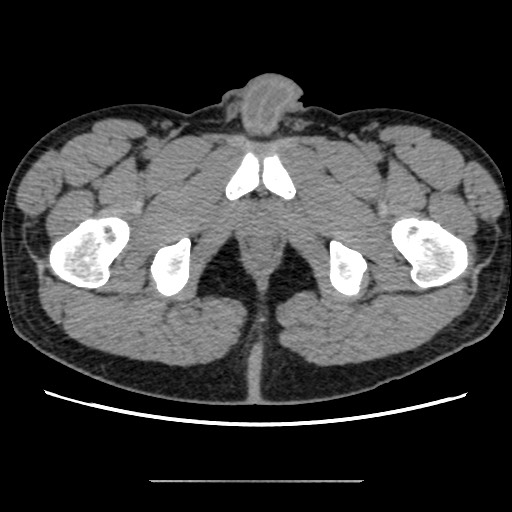 Chondrosarcoma of iliac wing (Radiopaedia 63861-72599 Axial non-contrast 120).jpg