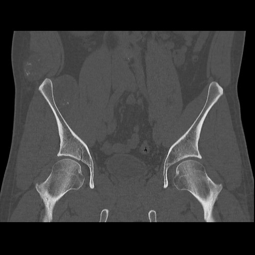 Chondrosarcoma of iliac wing (Radiopaedia 63861-72599 Coronal bone window 55).jpg