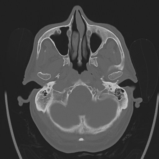 Chondrosarcoma of skull base- grade II (Radiopaedia 40948-43653 Axial bone window 5).png