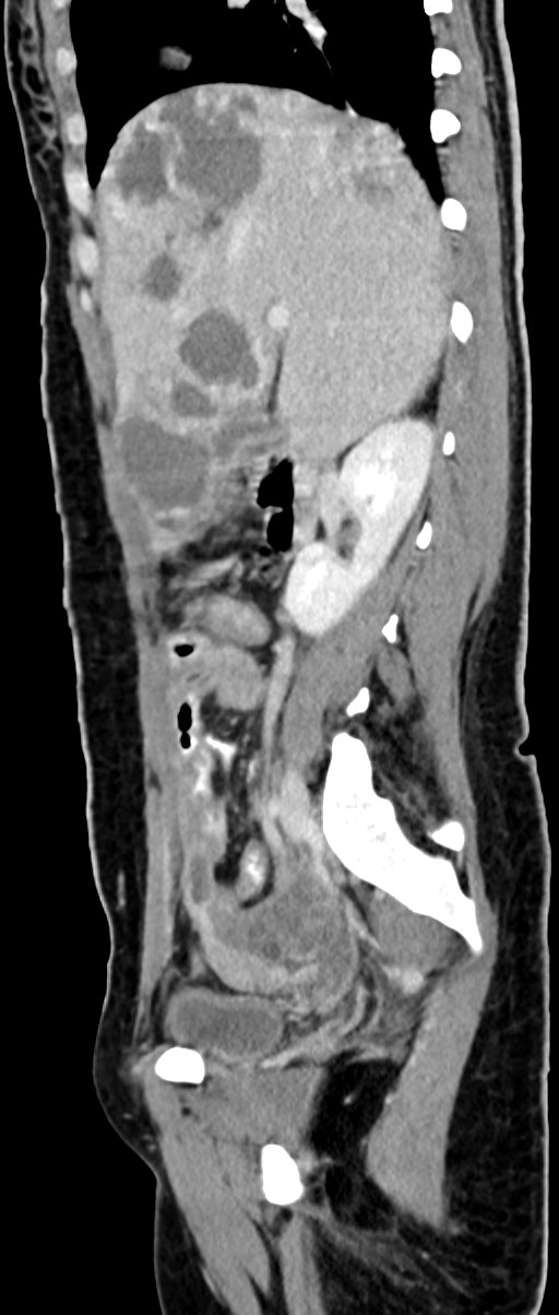 Choriocarcinoma liver metastases (Radiopaedia 74768-85766 C 116).jpg