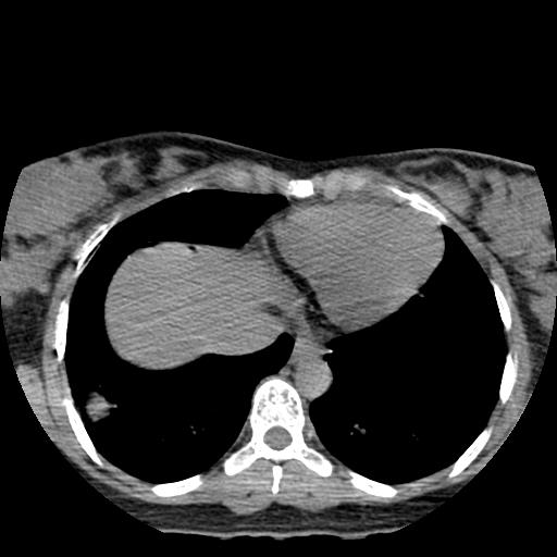 File:Choriocarcinoma of ovary with cerebral and pulmonary metastases (Radiopaedia 25983-26119 Axial non-contrast 21).jpg