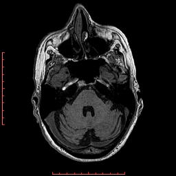 Choroid plexus xanthogranuloma (Radiopaedia 67843-77270 Axial T1 122).jpg