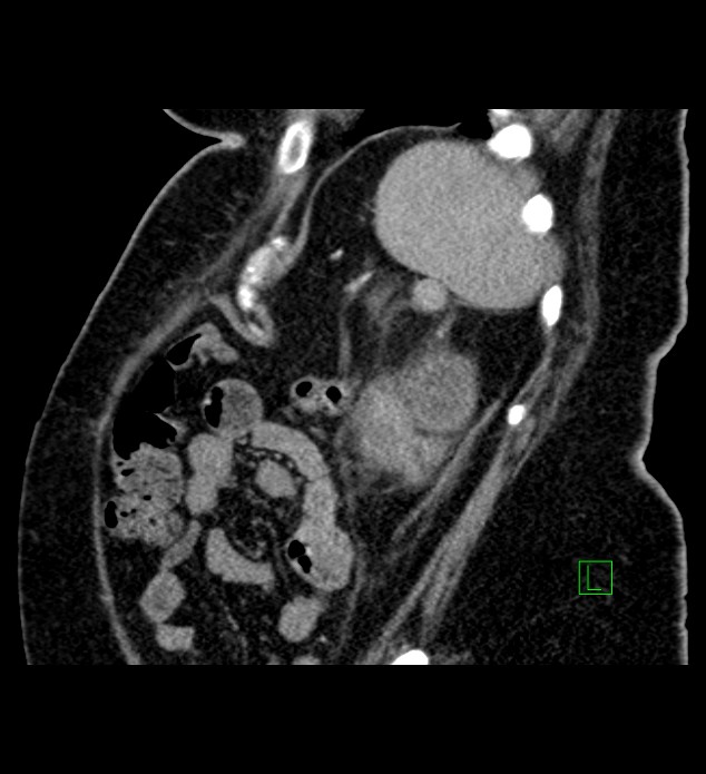 Chromophobe renal cell carcinoma (Radiopaedia 84239-99519 D 23).jpg