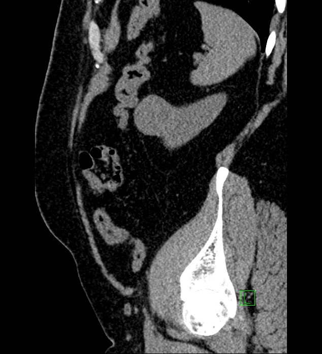 Chromophobe renal cell carcinoma (Radiopaedia 84286-99573 C 32).jpg