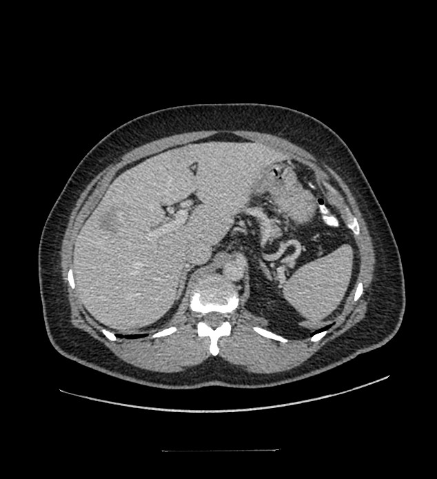 Chromophobe renal cell carcinoma (Radiopaedia 84337-99644 C 36).jpg