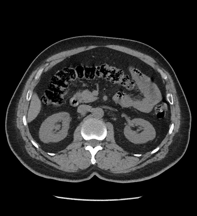 Chromophobe renal cell carcinoma (Radiopaedia 86879-103083 Axial non-contrast 37).jpg