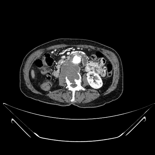 File:Chronic contained rupture of abdominal aortic aneurysm with extensive erosion of the vertebral bodies (Radiopaedia 55450-61901 A 26).jpg