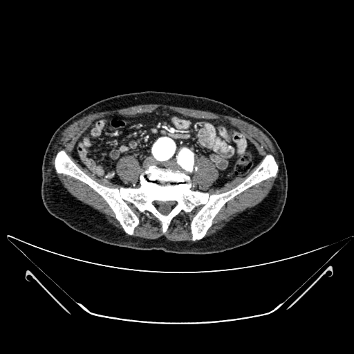 File:Chronic contained rupture of abdominal aortic aneurysm with extensive erosion of the vertebral bodies (Radiopaedia 55450-61901 A 50).jpg