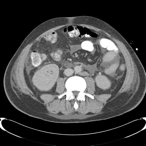 Chronic diverticulitis complicated by hepatic abscess and portal vein thrombosis (Radiopaedia 30301-30938 A 53).jpg