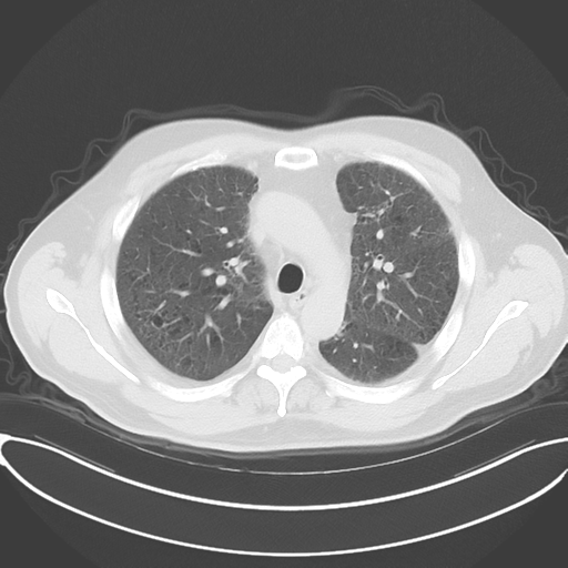 Chronic hypersensitivity pneumonitis (Radiopaedia 48107-52922 Axial lung window 23).png