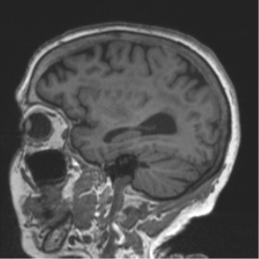 File:Chronic hypertensive encephalopathy (Radiopaedia 39993-42482 Sagittal T1 31).png