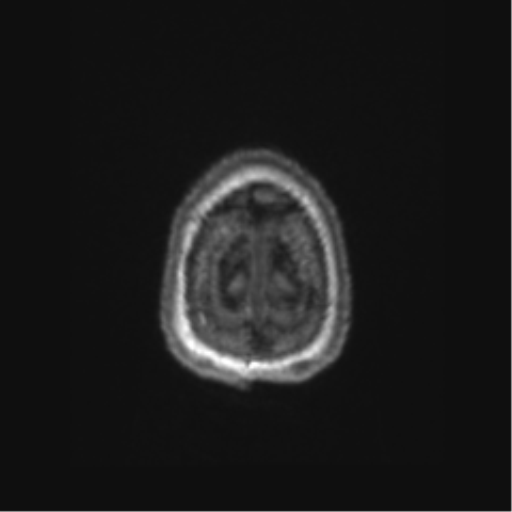 Chronic hypertensive encephalopathy (Radiopaedia 72844-83495 Axial T1 5).png