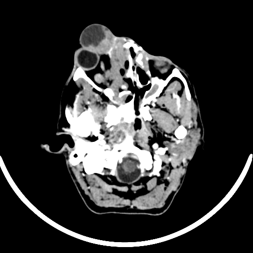 Chronic invasive fungal sinusitis with intraorbital and intracranial extension (Radiopaedia 56387-63046 B 69).jpg
