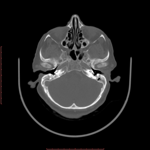 Chronic osteomyelitis - maxilla (Radiopaedia 23783-23927 Axial bone window 121).jpg