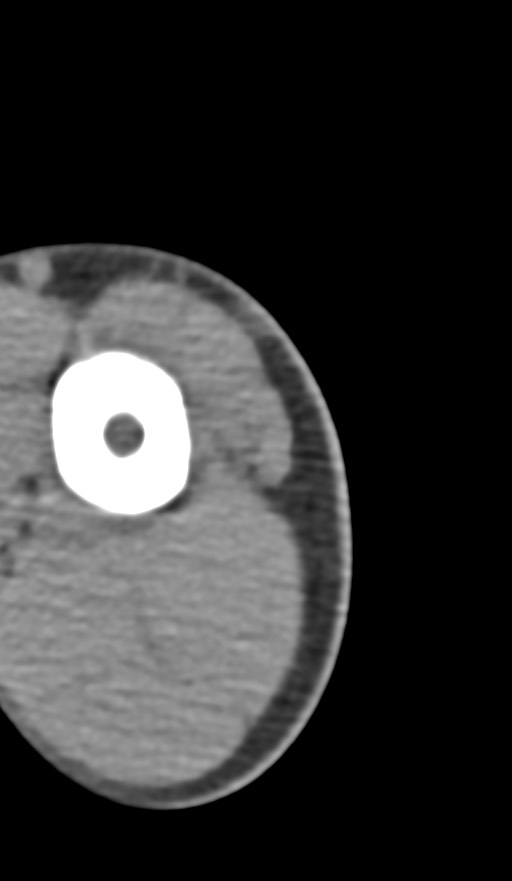 Chronic osteomyelitis of the distal humerus (Radiopaedia 78351-90971 Axial non-contrast 12).jpg