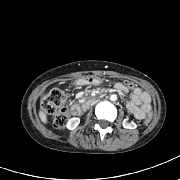 Chronic pancreatitis (Radiopaedia 55405-61846 A 48).jpg