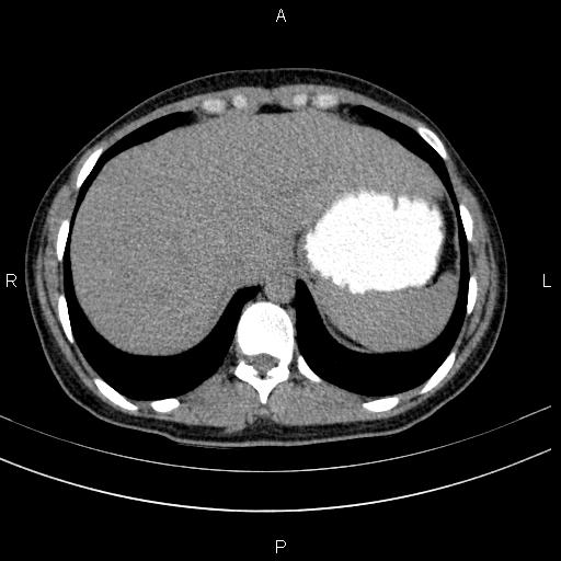 File:Chronic pancreatitis (Radiopaedia 64576-73450 Axial non-contrast 15).jpg