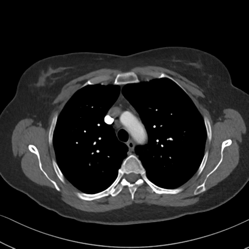 Chronic pulmonary embolus (Radiopaedia 39129-41341 Axial C+ CTPA 32).png