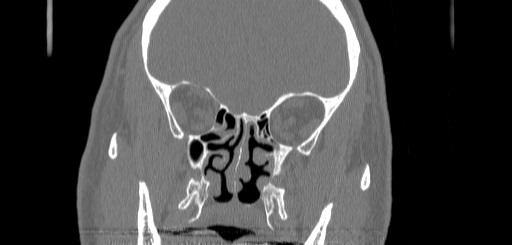 Chronic sphenoidal sinusitis (Radiopaedia 62030-70122 Coronal bone window 82).jpg