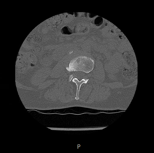 File:Chronic spinal hematoma with cauda equina syndrome (Radiopaedia 75745-88197 Axial bone window 2).png