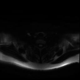 Chronic submandibular sialadenitis (Radiopaedia 61852-69885 Axial DWI 26).jpg