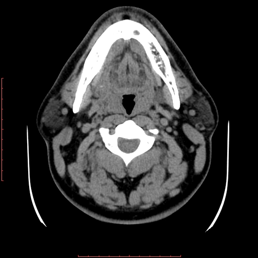 Chronic submandibular sialolithiasis (Radiopaedia 69817-79814 Axial non-contrast 96).jpg