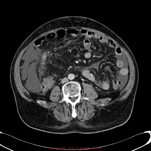 Cirrhosis and hepatocellular carcinoma in the setting of hemochromatosis (Radiopaedia 75394-86595 B 53).jpg