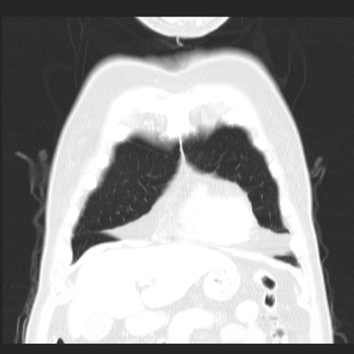 File:Classic complicated silicosis (Radiopaedia 49720-54961 Coronal lung window 7).jpg