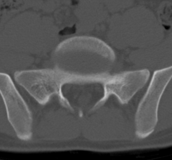 Clear cell meningoma - lumbar spine (Radiopaedia 60116-67691 Axial bone window 67).png