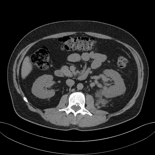 File:Clear cell renal cell carcinoma (Radiopaedia 61449-69393 Axial non-contrast 39).jpg