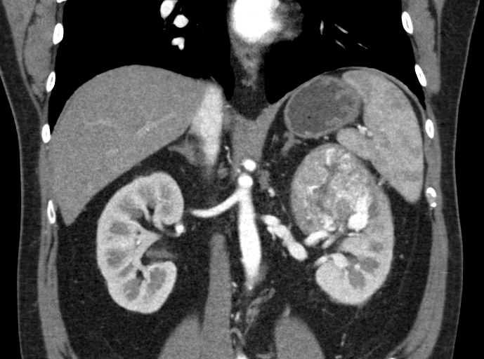 File:Clear cell renal cell carcinoma (Radiopaedia 61449-69393 C 21).jpg